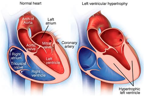 lv cavity dilated|what is dilated heart.